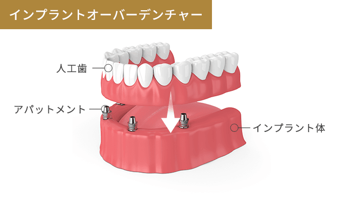 インプラントオーバーデンチャー｜京都のインプラント治療は八幡市の 